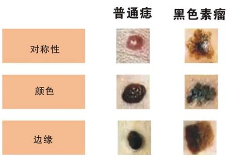 好痣顏色|這是痣，還是黑色素癌？